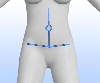 scars tummy tuck fleur-de-lis